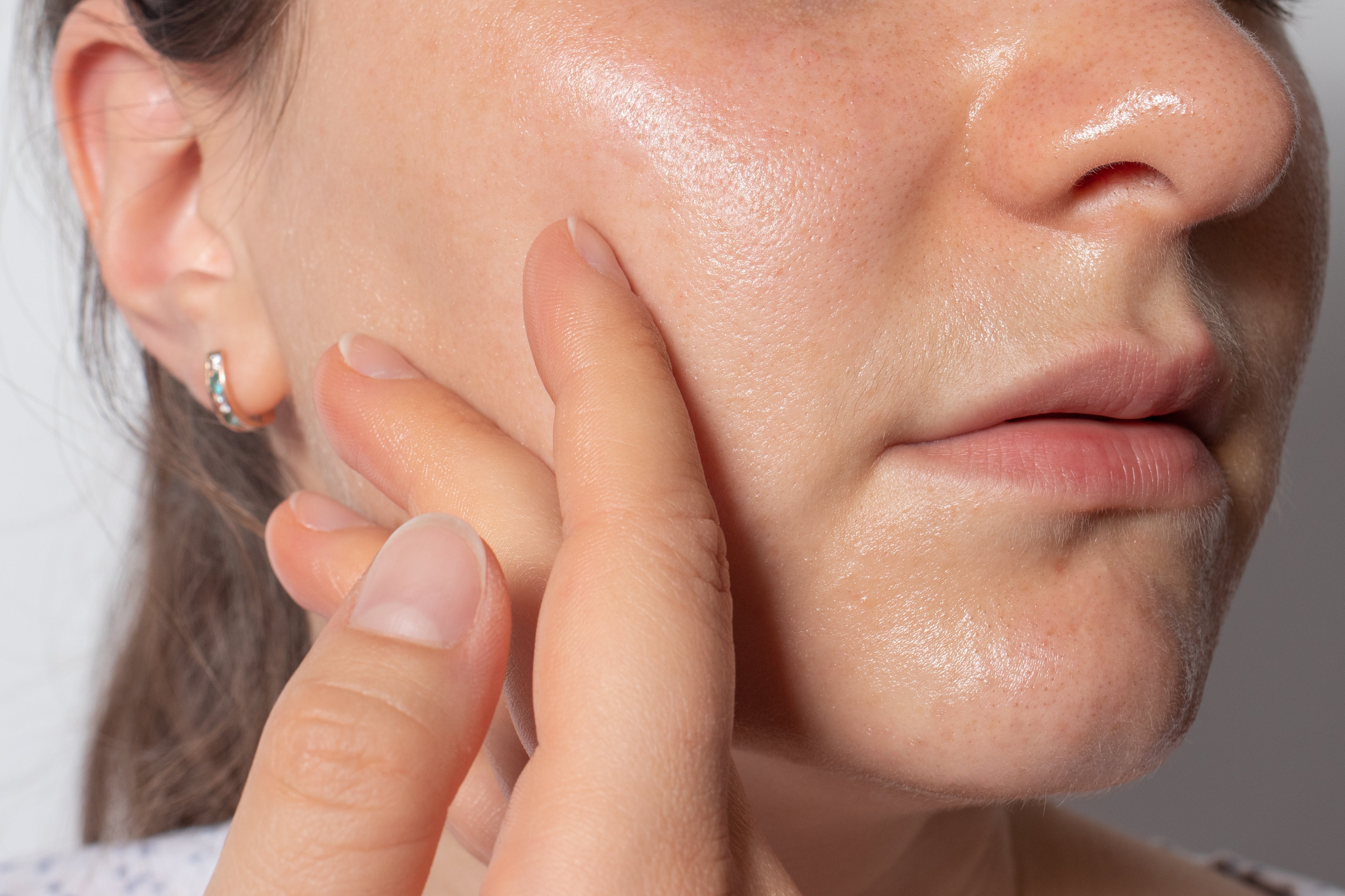 DIY Essential Oil Blends to Treat Acne