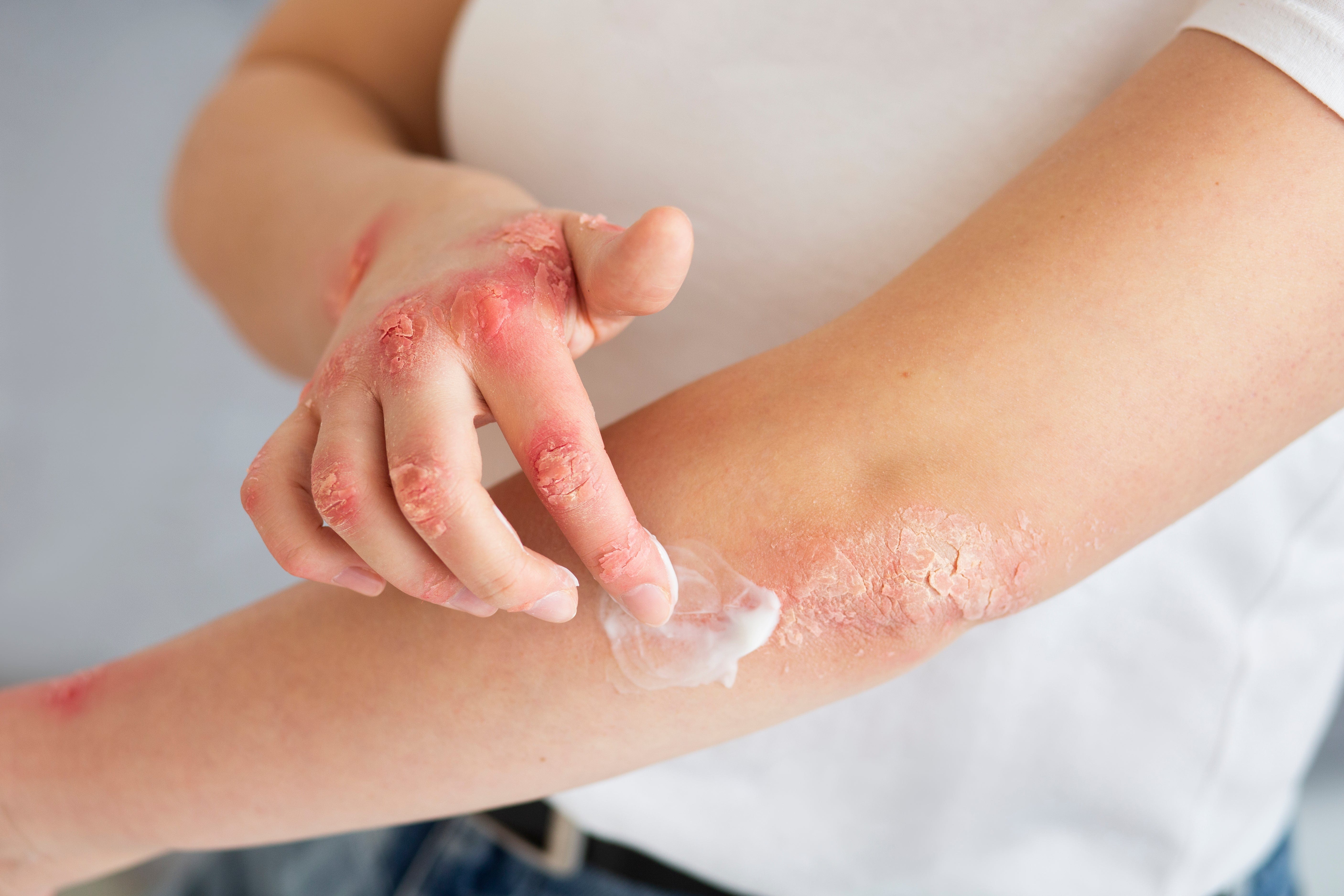 Eczema & Dermatitis